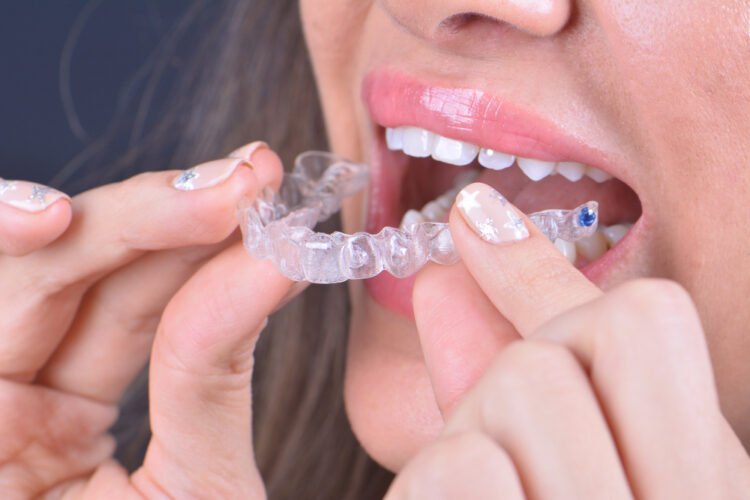 Invisalign Windsor