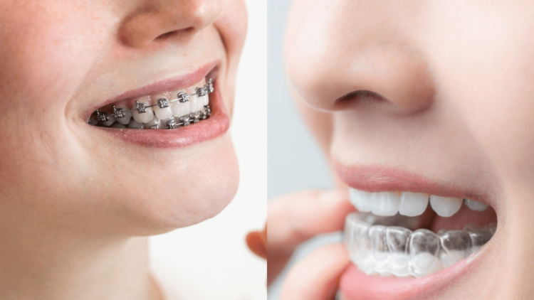 Invisalign Windsor