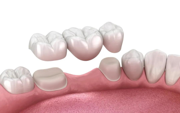 Tooth Replacement